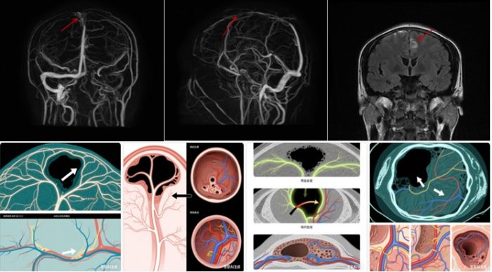 颅内静脉窦危机解密: 藏在脑内的“隐形血栓”