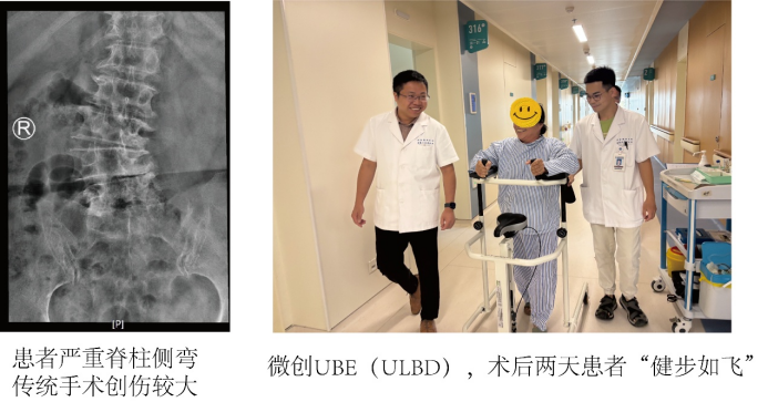 前沿技术·共筑健康梦想丨患有腰椎间盘突出的男女老少，“直腰有望”！瑞金海南医院常规开展这项手术→