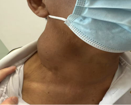 拳头大甲状腺巨瘤侵犯命脉 海南医科大学第一附属医院多学科团队精准“排雷”