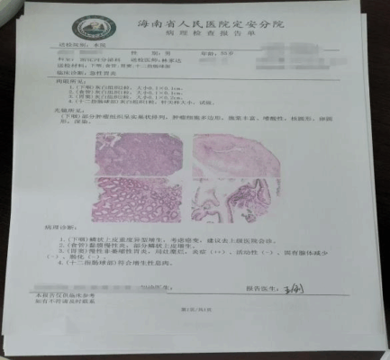 海南省人民医院定安分院成功实施首例下咽早癌内镜微创治疗