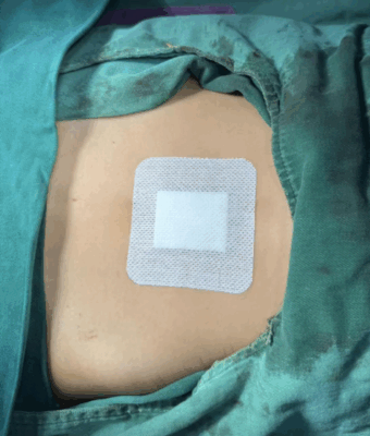 7岁女孩检出12cm卵巢肿瘤！单孔腹腔镜“隐痕”手术守护生育力