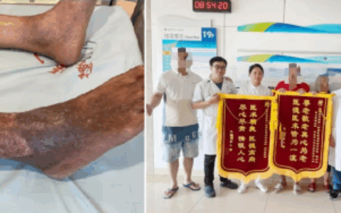 24年“老烂腿”终愈合!创面修复技术为患者成功保肢