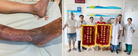 24年“老烂腿”终愈合!创面修复技术为患者成功保肢