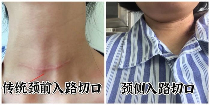 海南省第二人民医院开展经侧颈部小切口胸锁乳突肌肌间入路甲状腺切除术