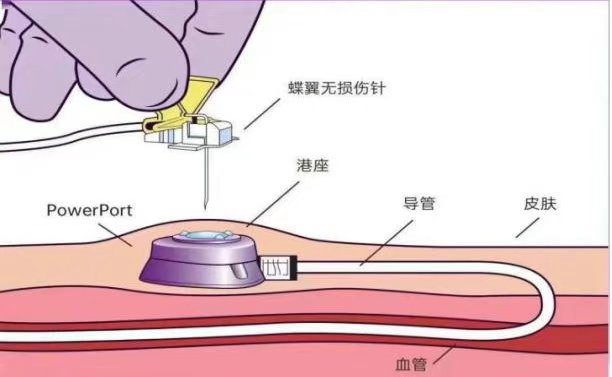 海医二院肿瘤内科常规开展超声引导下腔内心电图定位上臂输液港植入技术
