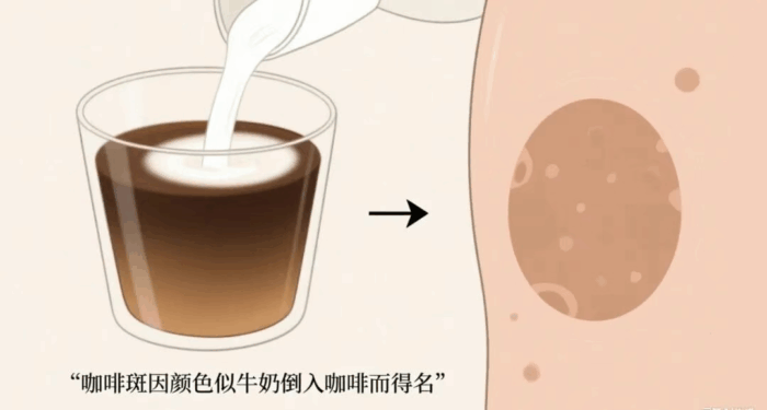 “咖啡斑”不只是“小色斑”？这些皮肤信号千万别忽视！