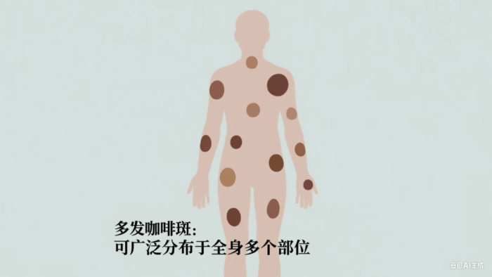 “咖啡斑”不只是“小色斑”？这些皮肤信号千万别忽视！