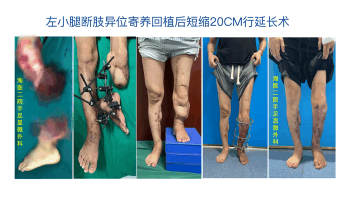 海医二院成功为严重离断伤患者保住左腿，助其重返行走人生