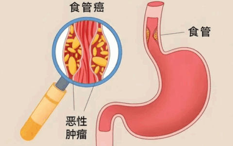 70岁晚期食管癌大爷，从滴水难进到顺利进食，他们如何做到？