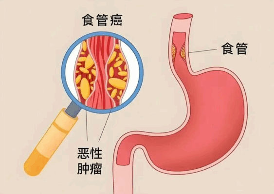 70岁晚期食管癌大爷，从滴水难进到顺利进食，他们如何做到？