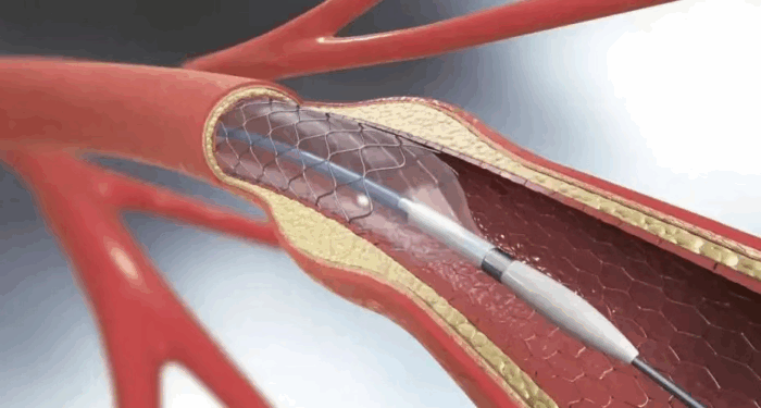 70岁晚期食管癌大爷，从滴水难进到顺利进食，他们如何做到？