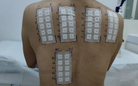 解放军总医院海南医院推出皮肤病“过敏原侦探”斑贴技术