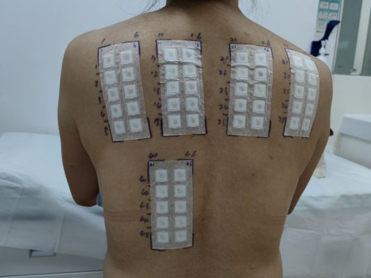 解放军总医院海南医院推出皮肤病“过敏原侦探”斑贴技术