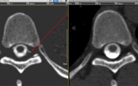 解放军总医院海南医院成功完成一例CT脑池造影术锁定罕见“脑脊液漏”手术