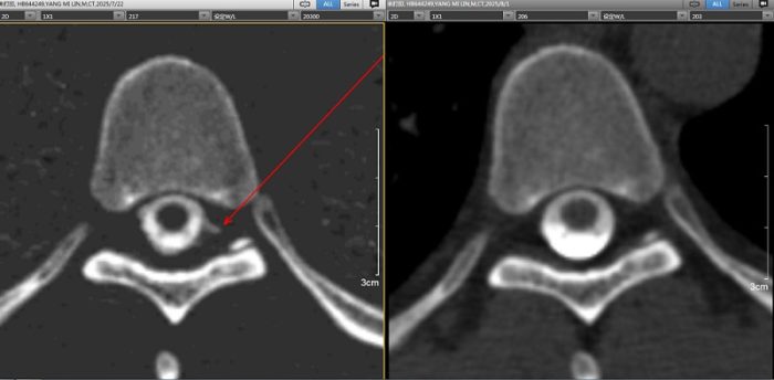 解放军总医院海南医院成功完成一例CT脑池造影术锁定罕见“脑脊液漏”手术