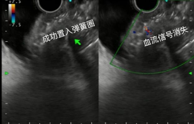 男子消化道反复出血,元凶竟是3厘米“定时炸弹”!