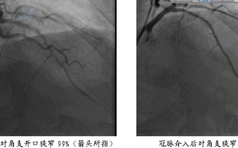夫妻俩前后脚突发心肌梗死 军医60分钟抢救创生命奇迹
