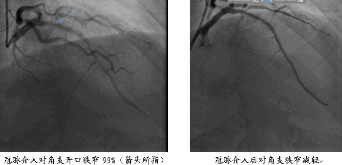 夫妻俩前后脚突发心肌梗死 军医60分钟抢救创生命奇迹