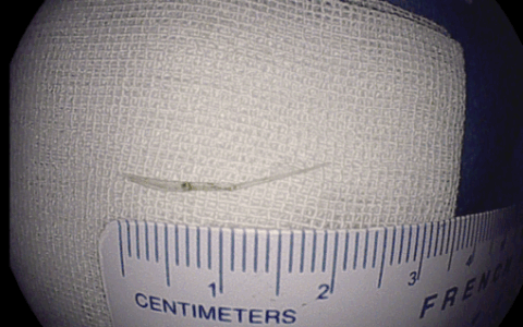 一根鱼刺“潜伏”16天，辗转多地终在海医二院被“缉拿”