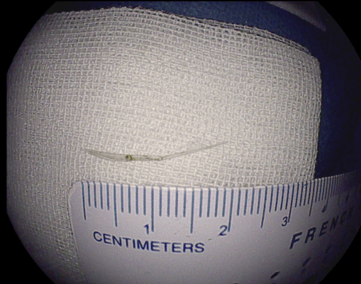 一根鱼刺“潜伏”16天，辗转多地终在海医二院被“缉拿”