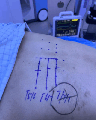 古稀老人饱受带状疱疹后遗神经痛折磨上海六院海口医院“小”针解决“大”痛苦