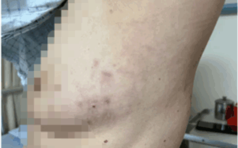 古稀老人饱受带状疱疹后遗神经痛折磨上海六院海口医院“小”针解决“大”痛苦 