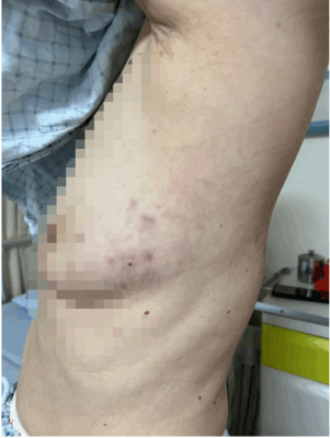 古稀老人饱受带状疱疹后遗神经痛折磨上海六院海口医院“小”针解决“大”痛苦