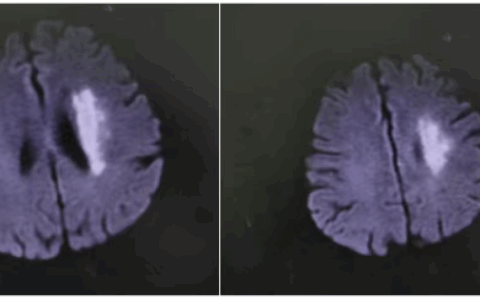 黄金时间窗过了怎么办？71岁阿婆脑主干血管闭塞，医生这样抢回大脑！