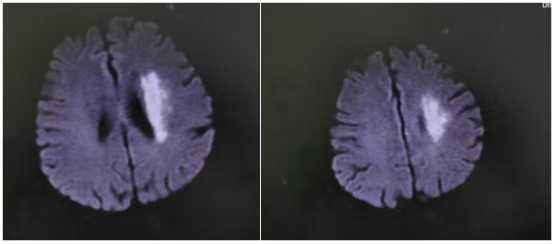 黄金时间窗过了怎么办？71岁阿婆脑主干血管闭塞，医生这样抢回大脑！