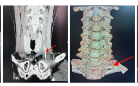 “离颈动脉只差2毫米！”，一根3厘米鱼刺的12天“生死潜伏”