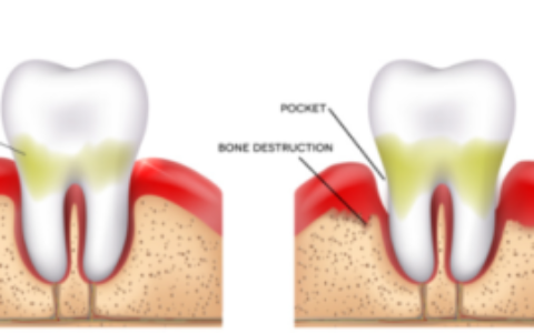 36 岁 11 颗牙松动：牙周炎正悄悄毁掉年轻人的牙
