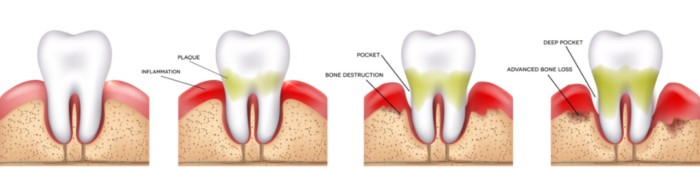 36 岁 11 颗牙松动：牙周炎正悄悄毁掉年轻人的牙