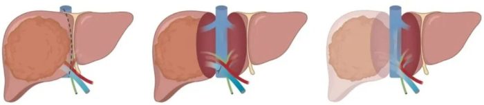 从跨海求医到返岛根治：高难度手术让六旬肝癌患者重获新生