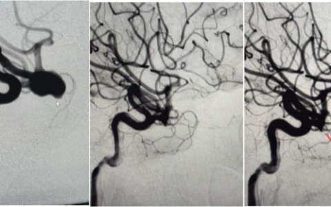 海医二院神经外科完成首例WEB颅内动脉瘤栓塞系统置入术