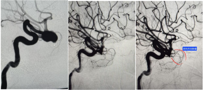 海医二院神经外科完成首例WEB颅内动脉瘤栓塞系统置入术