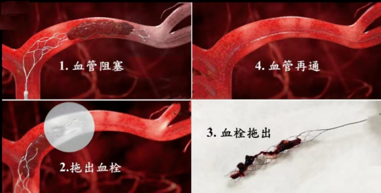 46岁男子突发头晕、肢体麻木无力5小时 海南省人民医院定安分院多学科协作高效救治