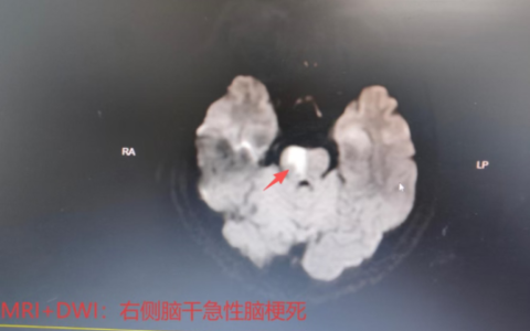 46岁男子突发头晕、肢体麻木无力5小时 海南省人民医院定安分院多学科协作高效救治