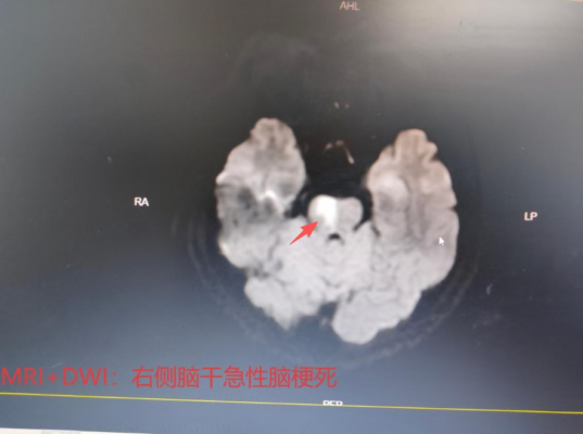 46岁男子突发头晕、肢体麻木无力5小时 海南省人民医院定安分院多学科协作高效救治