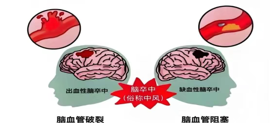 46岁男子突发头晕、肢体麻木无力5小时 海南省人民医院定安分院多学科协作高效救治