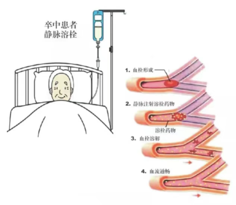 46岁男子突发头晕、肢体麻木无力5小时 海南省人民医院定安分院多学科协作高效救治