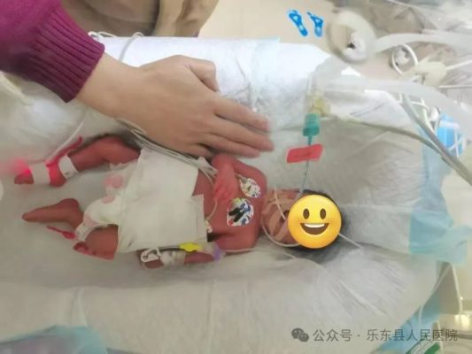 74天生命闯关:乐东县人民医院成功救治26周超早产儿