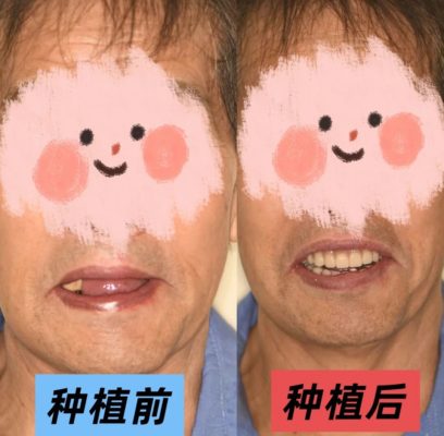 70岁种11颗牙，当天就能吃饭？医生：只要满足这些条件