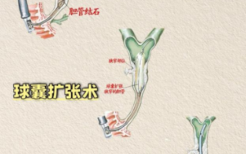 从“住院数日”到“日间康复”：海医二院肝胆胰外科ERCP技术迈入“日间手术”时代