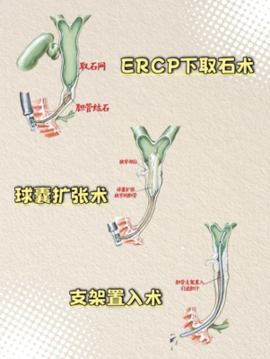 从“住院数日”到“日间康复”:海医二院肝胆胰外科ERCP技术迈入“日间手术”时代