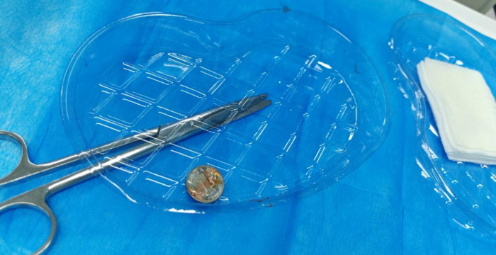  3分钟“镜”准除险！澄迈县人民医院成功为 2 岁幼童取出胃内误食硬币