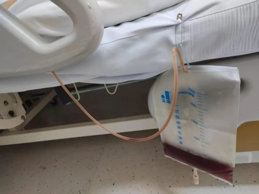 血压250、尿液酱油色...我院打破常规，成功救治危重HELLP综合征孕妇