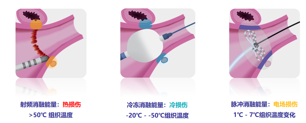 房颤消融治疗目前的三种主流方式.png