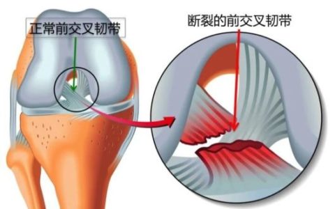 海南省人民医院运动医学科高效救治加拿大专家前交叉韧带撕裂