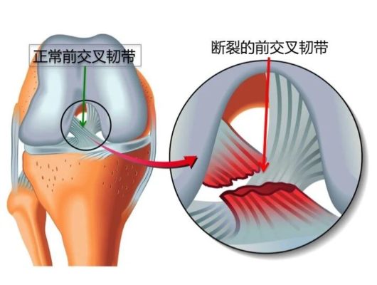 海南省人民医院运动医学科高效救治加拿大专家前交叉韧带撕裂