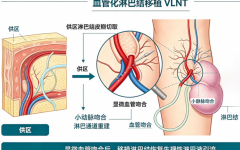 海医一附院成功实施血管化淋巴结皮瓣移植术